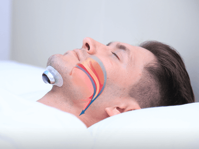 Rechargeable Anti-Snoring Device with Pulse Technology